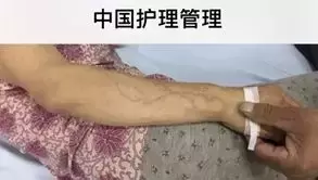 肝素钠也能治静脉炎？效果好吗？看这篇~