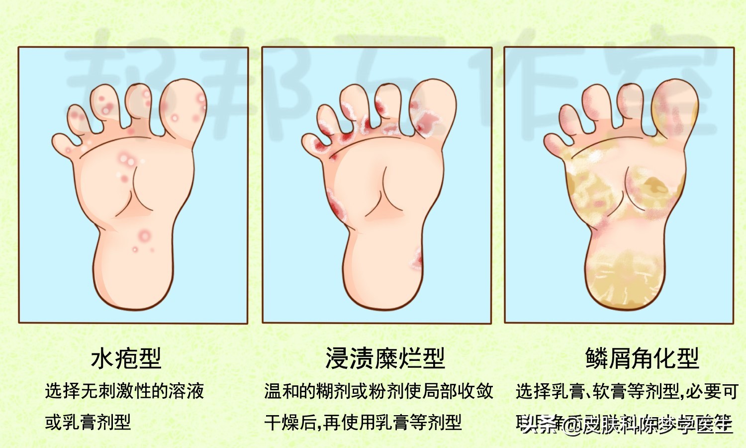 脚气类型鉴别图图片