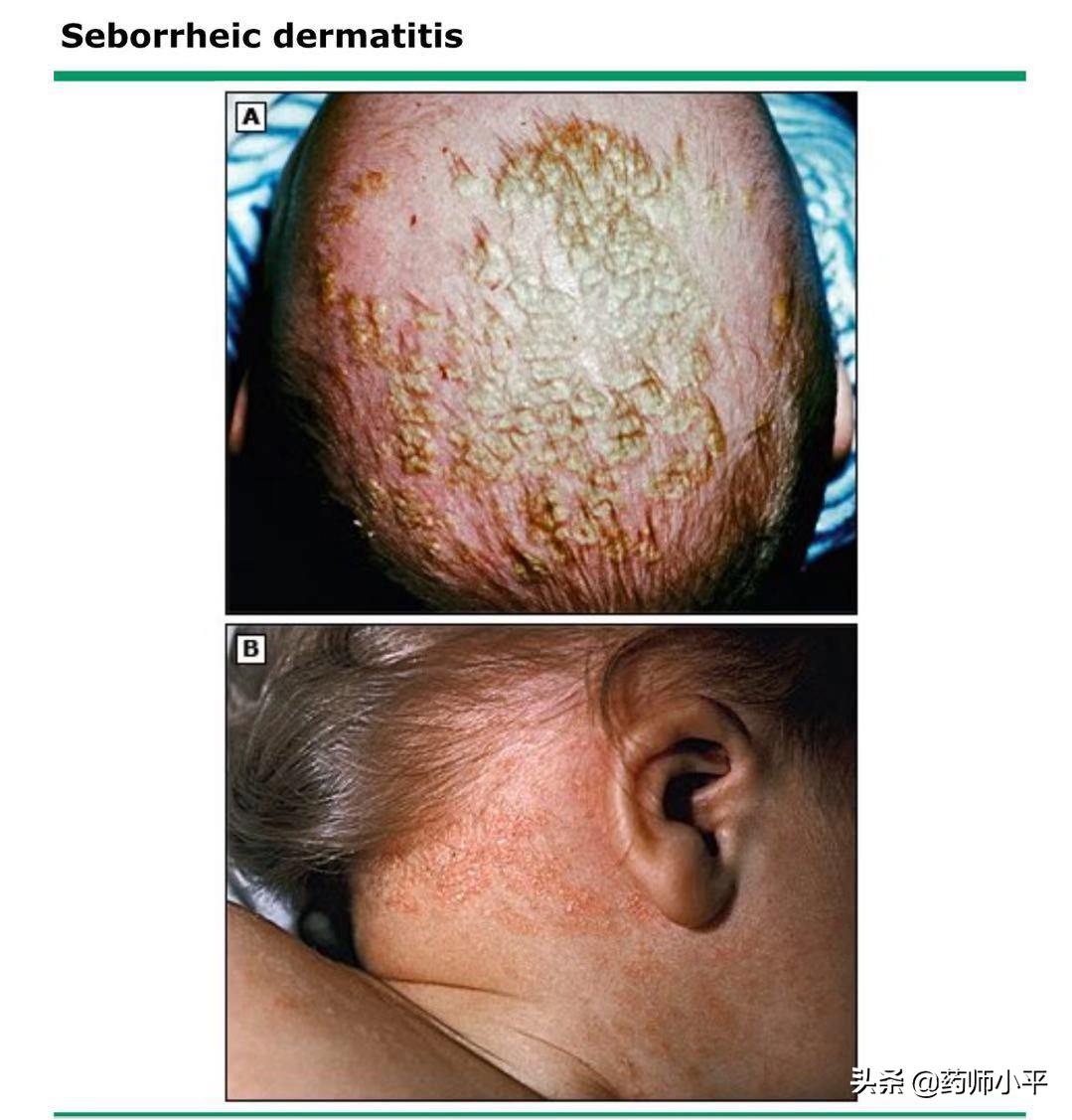 宝宝头皮黄色鳞屑、爸爸头皮屑多都是脂溢性皮炎？怎么治疗？