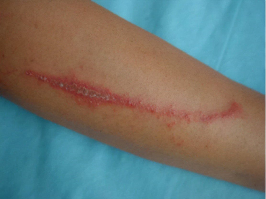 被隐翅虫咬伤急救指南,毒液酸性或可堪比硫酸?