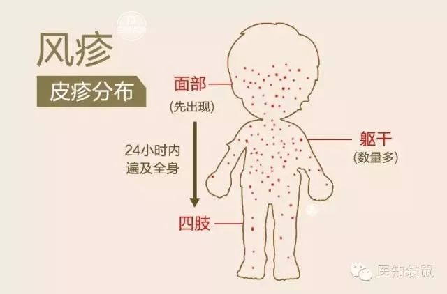 2岁内宝宝发热反复不退是幼儿急疹?如何与风疹,麻疹区分?