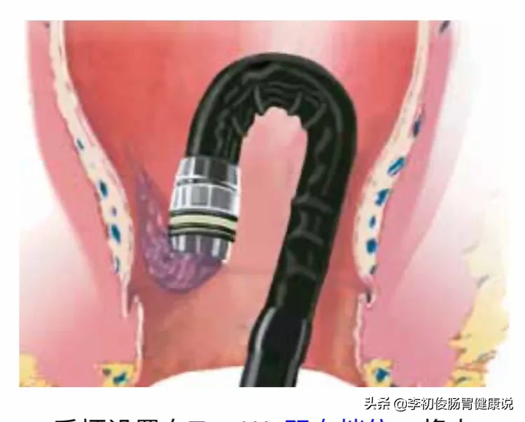一次肠镜操作,一举三得同时完成肠道检查、套扎止血、消除内痔!