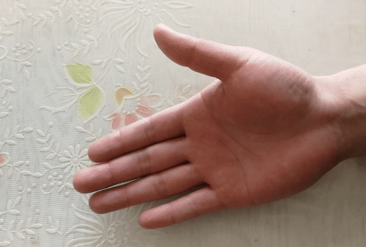 中老年女性常手指疼痛、肿胀，是腱鞘炎吗？该怎么办？告知您