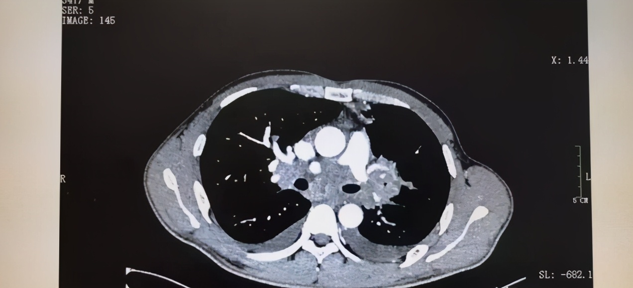 肺癌一查就是晚期？其实身体曾给你5次“暗示”，只是被你忽略了