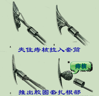 内痔套扎疗效好，并发症少，是国际公认最佳的门诊治疗方法