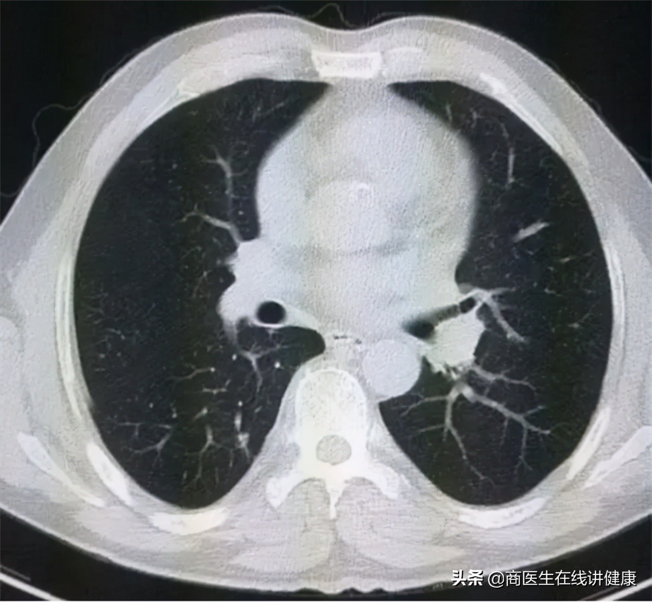 如何让你的肺结节变小甚至消失？
