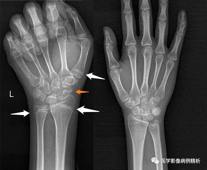 垂体柄阻断综合征并股骨头骨骺滑脱MR典型影像表现及分析思路