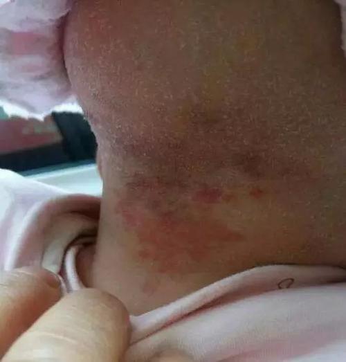 "马牙,螳螂嘴,鹤咬痕",宝宝若出现这些异常现象,妈妈先莫慌