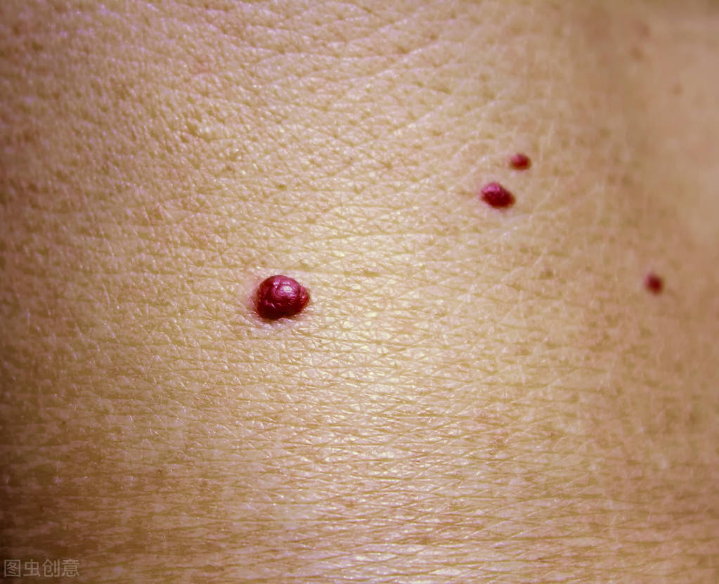 孩子身上长着血红色疙瘩是什么？可能是血管瘤，这6种类型你记住了吗？