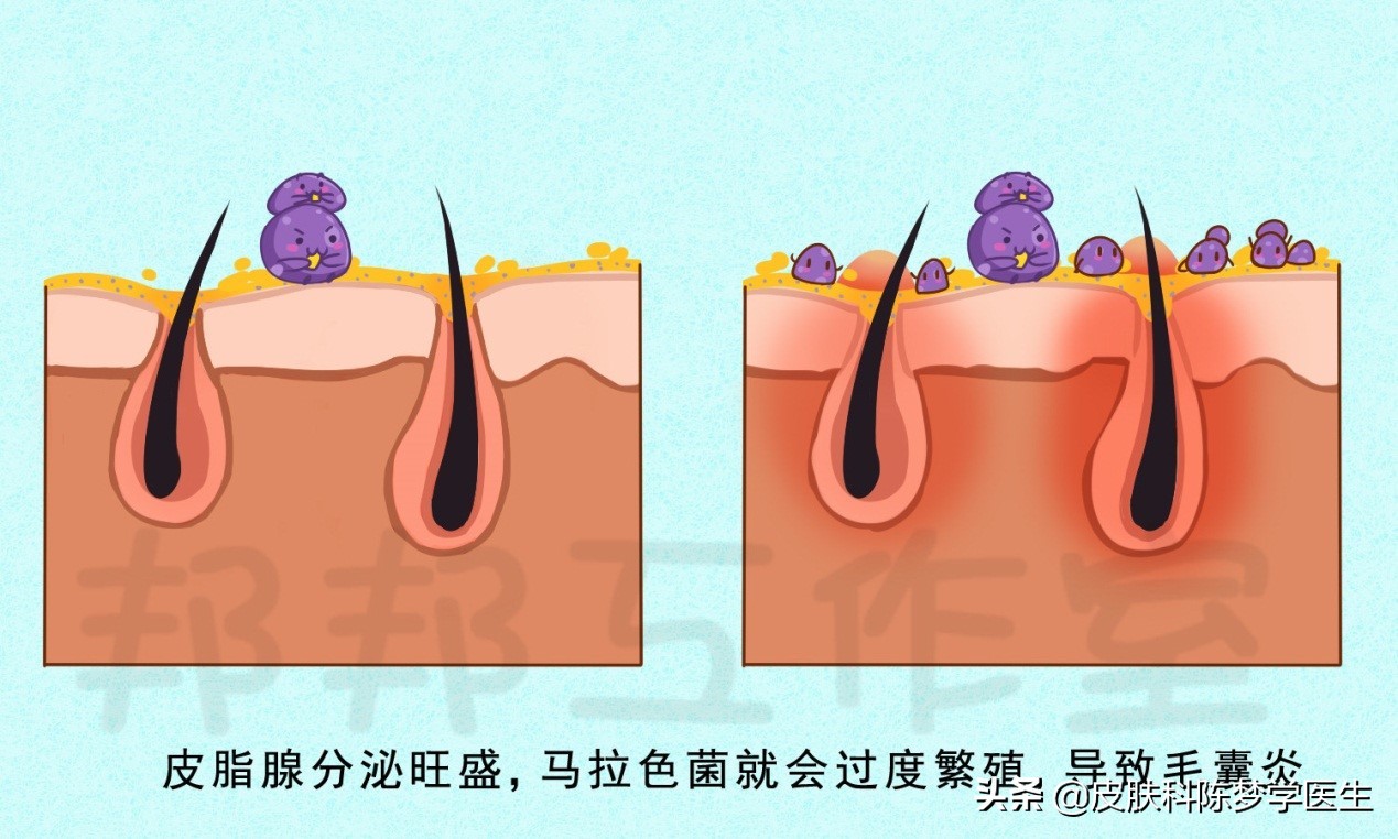 痘痘始终不好，小心是马拉色菌惹的祸