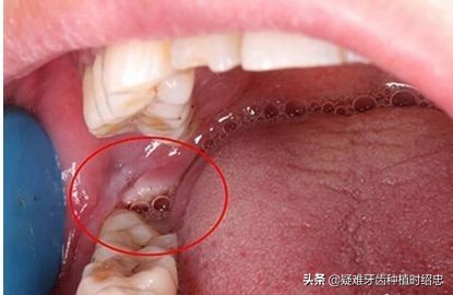 干槽症是怎么发生的?