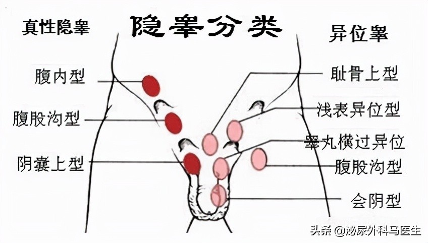 关于隐睾，你必须要知道的4件事：