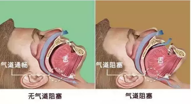 宝宝打呼噜别大意，它可能是疾病的征兆