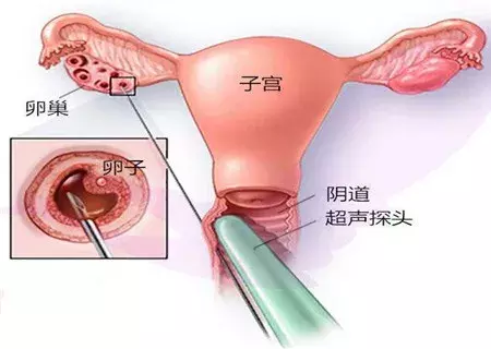大二女生卖卵,三天后肚子大如孕妇险丧命!卖卵的危害有多大?