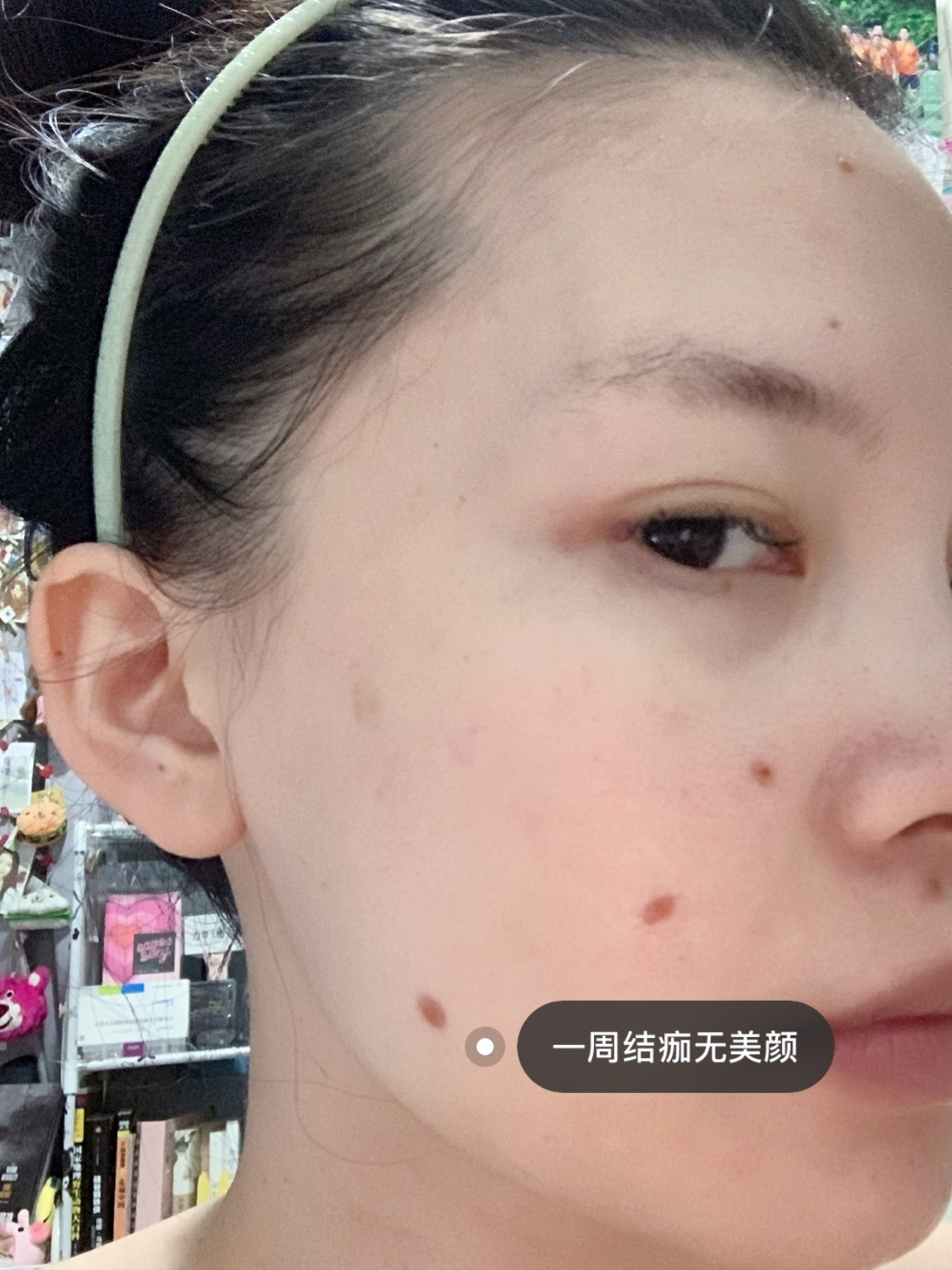 激光点痣+护理全程分享