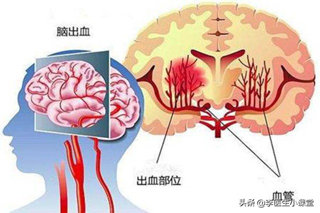 女子头痛晕倒入院，确诊脑出血，医生：5症状出现一个，就要警惕