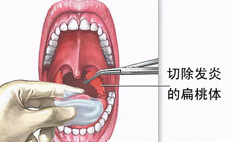 3类孩子易患扁桃体炎，家长注意：调理脾胃，少走弯路才是关键