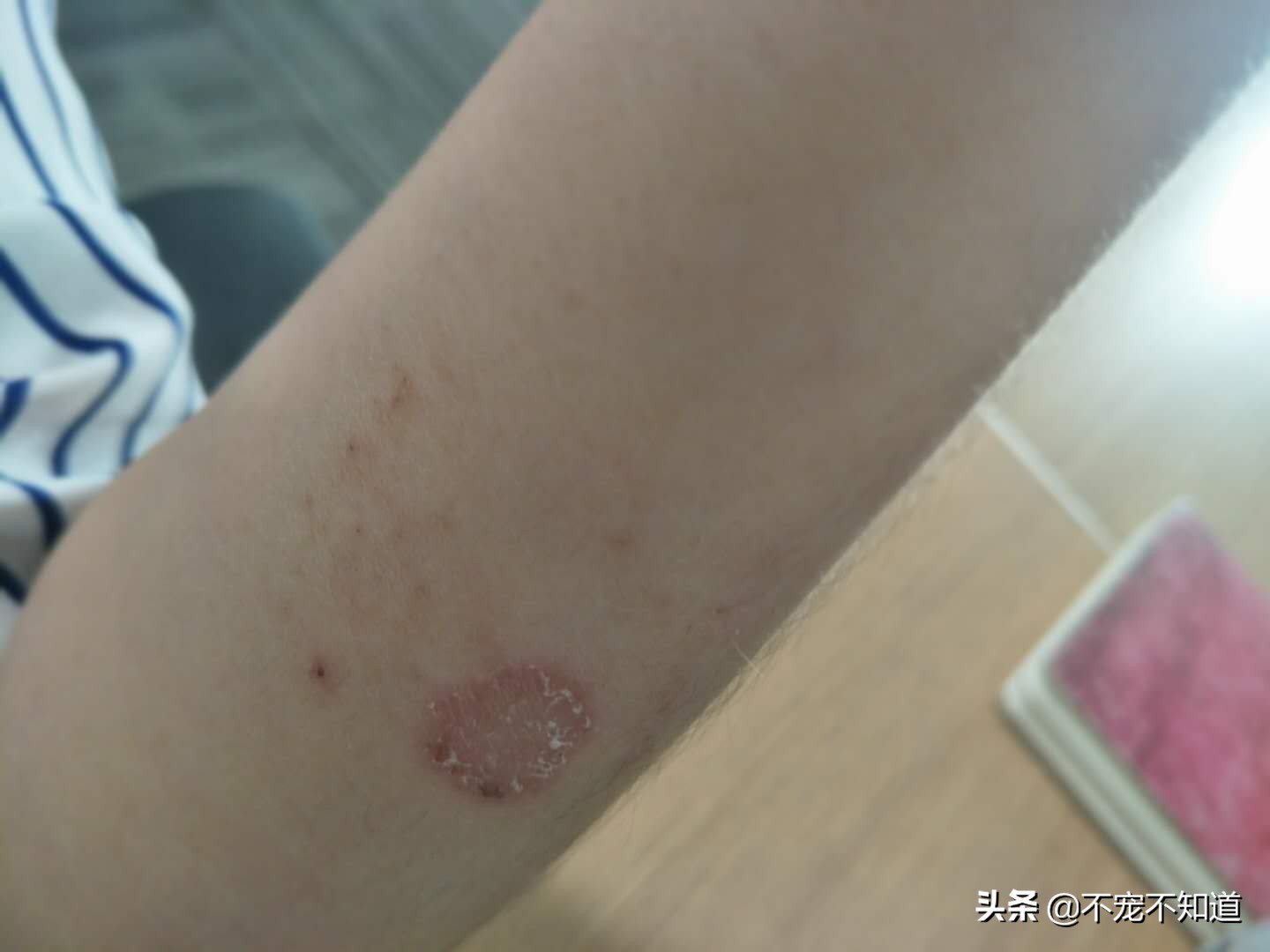 怎么判断是不是猫藓？教你一招如何迅速辨别