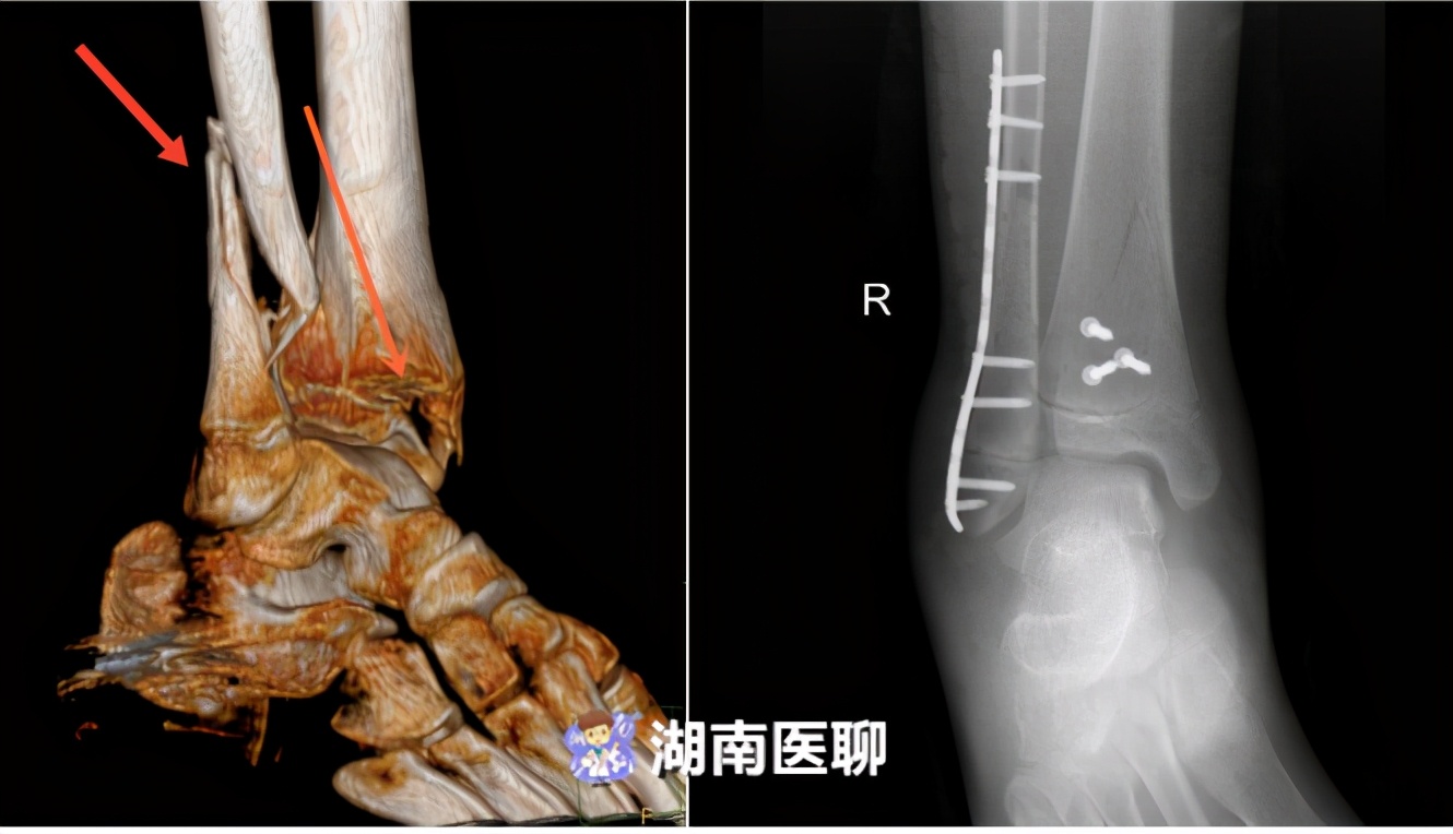 6周,完全負重行走則需要術後 12～16 周複查x 線片有明顯連續骨痂形