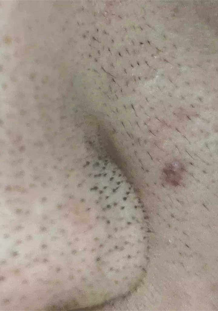 用什么方法去除鼻子上的黑头最有效?