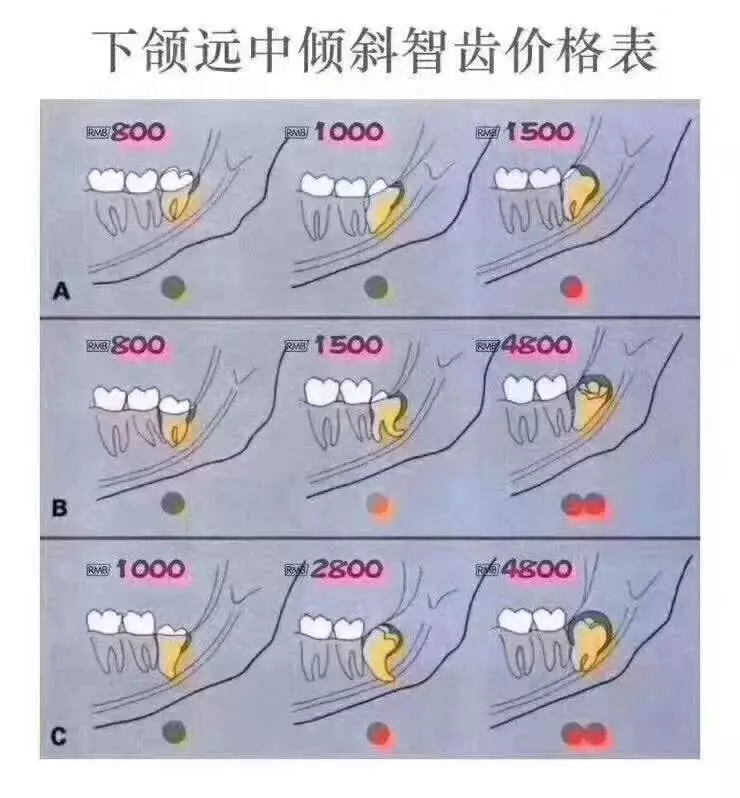 埋得越深，分手费越高——你所不知道的拔智齿收费依据