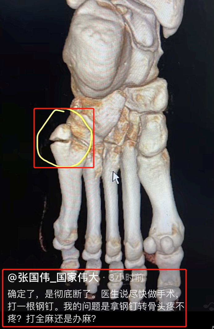 断腿图片在医院的图片(30岁张国伟因训练过猛骨折!