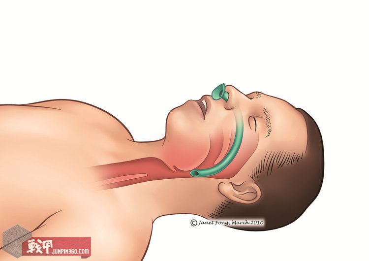 维持气道畅通！——浅谈战术急救呼吸保障技术