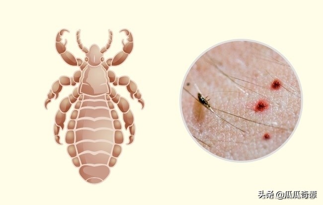 则表明可能是被虱子叮咬了,这些斑点距离都非常的接近,皮肤看起来像是