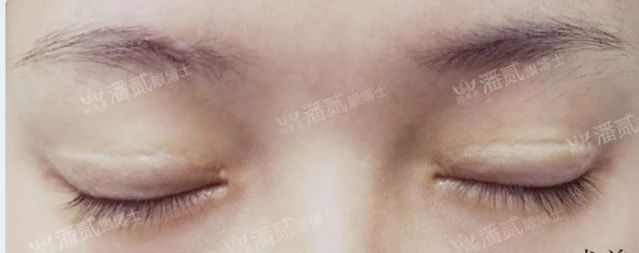 双眼皮失败后闭眼痕迹明显:瘢痕明显,切口凹陷等,你属于哪种?