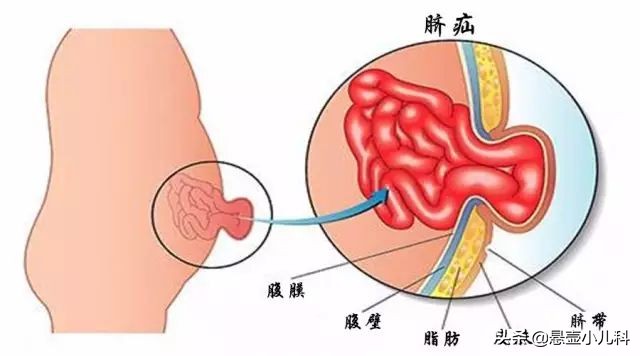 1个月大婴儿脐疝本可自愈，无知父母刀片“放气”却险送命！