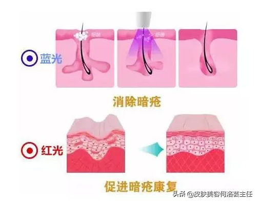 治痘神器——红蓝光，效果怎么样？到底有没有用？