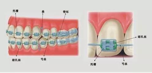 省钱选择“钢丝矫正”，这些你事情需要知晓