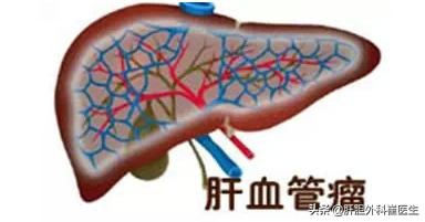 体检发现肝血管瘤或肝囊肿，肝胆外科医生告诉你什么时候该手术