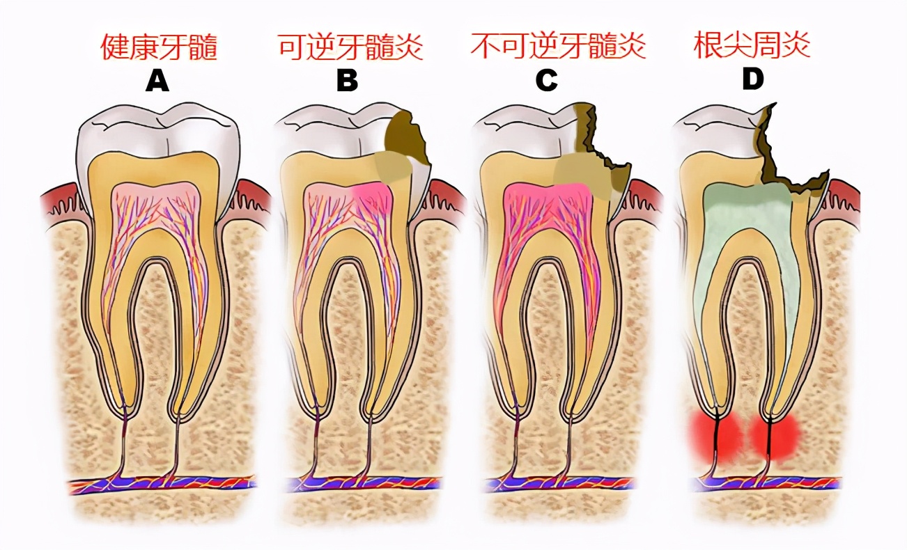 死髓牙和活髓牙圖片(寶寶蛀牙不疼更可怕) - 赤虎壹號