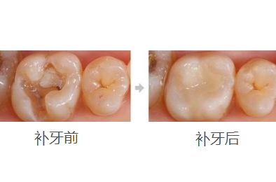 补牙价格参差不齐，究竟“差”在哪？