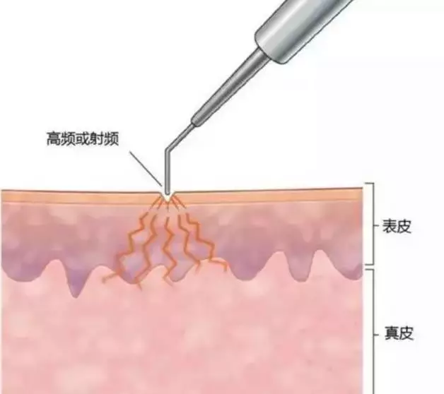 点痣需谨慎，方法很多，但一定要到正规机构选择正规方法