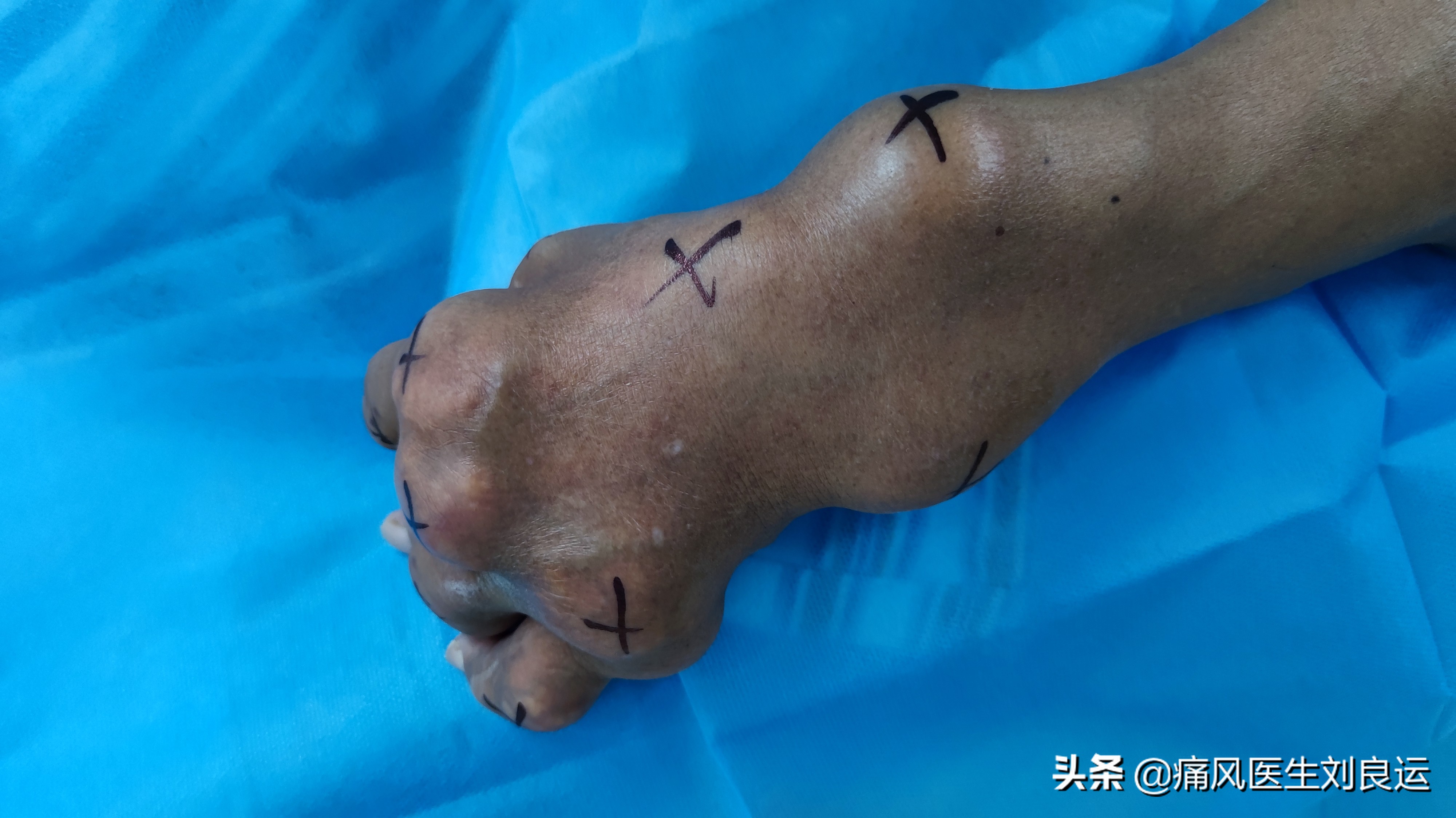 痛风石手术多少钱四肢关节长满痛风石的他一年后来医院