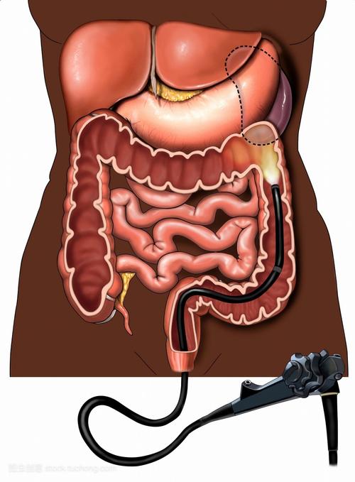 普通肠镜和无痛肠镜有什么区别？知道这些可以避免很多坑