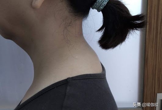 脖子后面凸一包是“富贵包”吗？如何消除？这个方法简单又有效