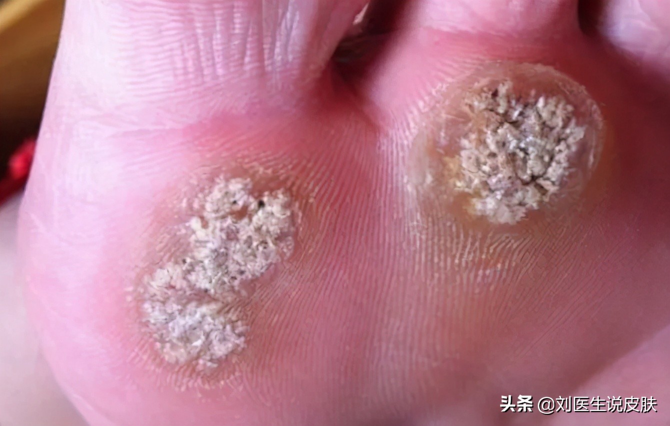 脚底长硬疙瘩，是鸡眼or跖疣？医生：区分在前，治疗在后！一文懂