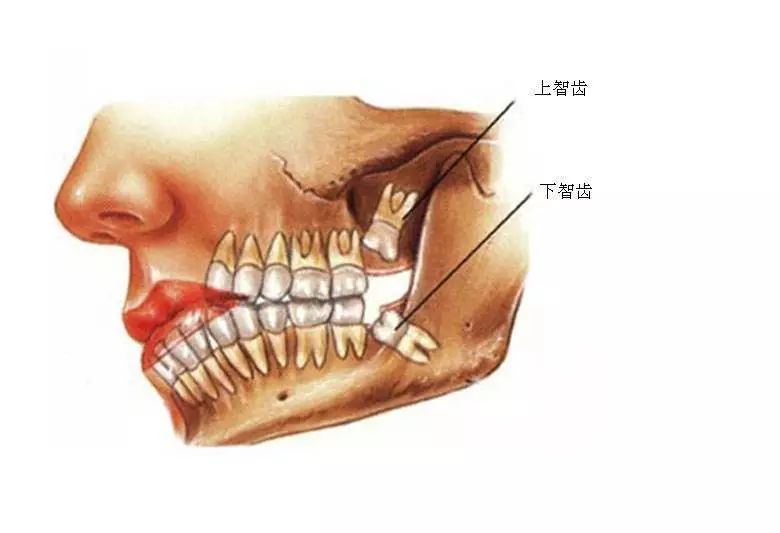 看着都疼！男子没钱拔智齿用电钻自己拔，导致半张脸瘫痪