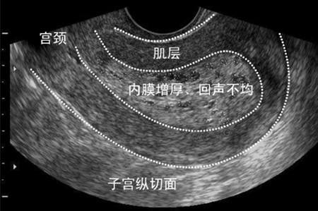 子宫内膜增厚影响怀孕？科学调理助好孕