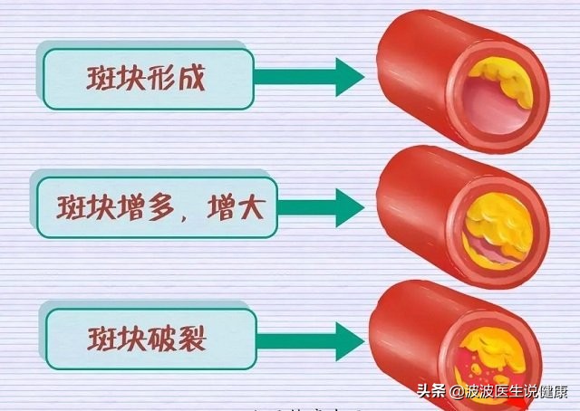 三高（高血压、高血脂、高血糖），哪一个对人的威胁和危害最大