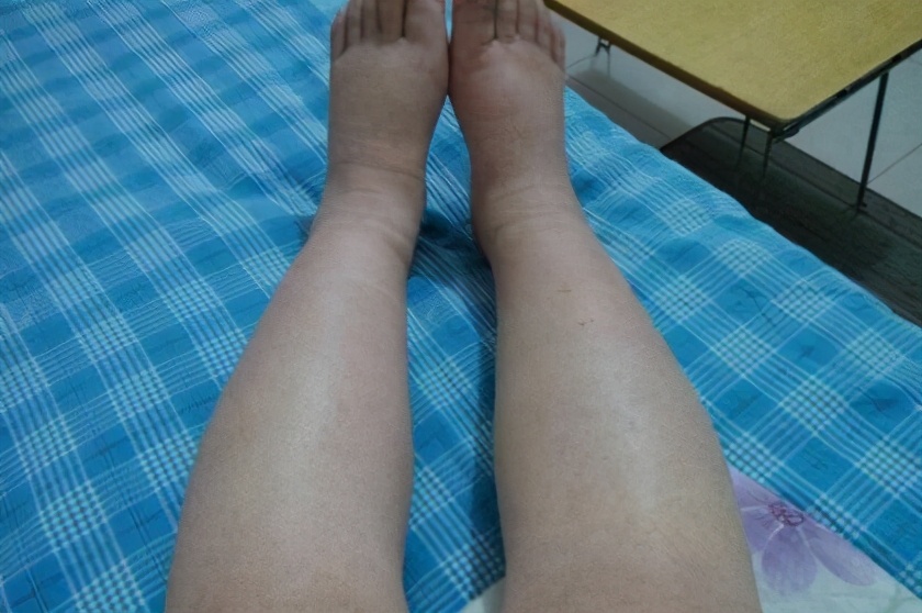 肝腹水早起症状有哪些,怎么预防?医生:做好这4件事就行