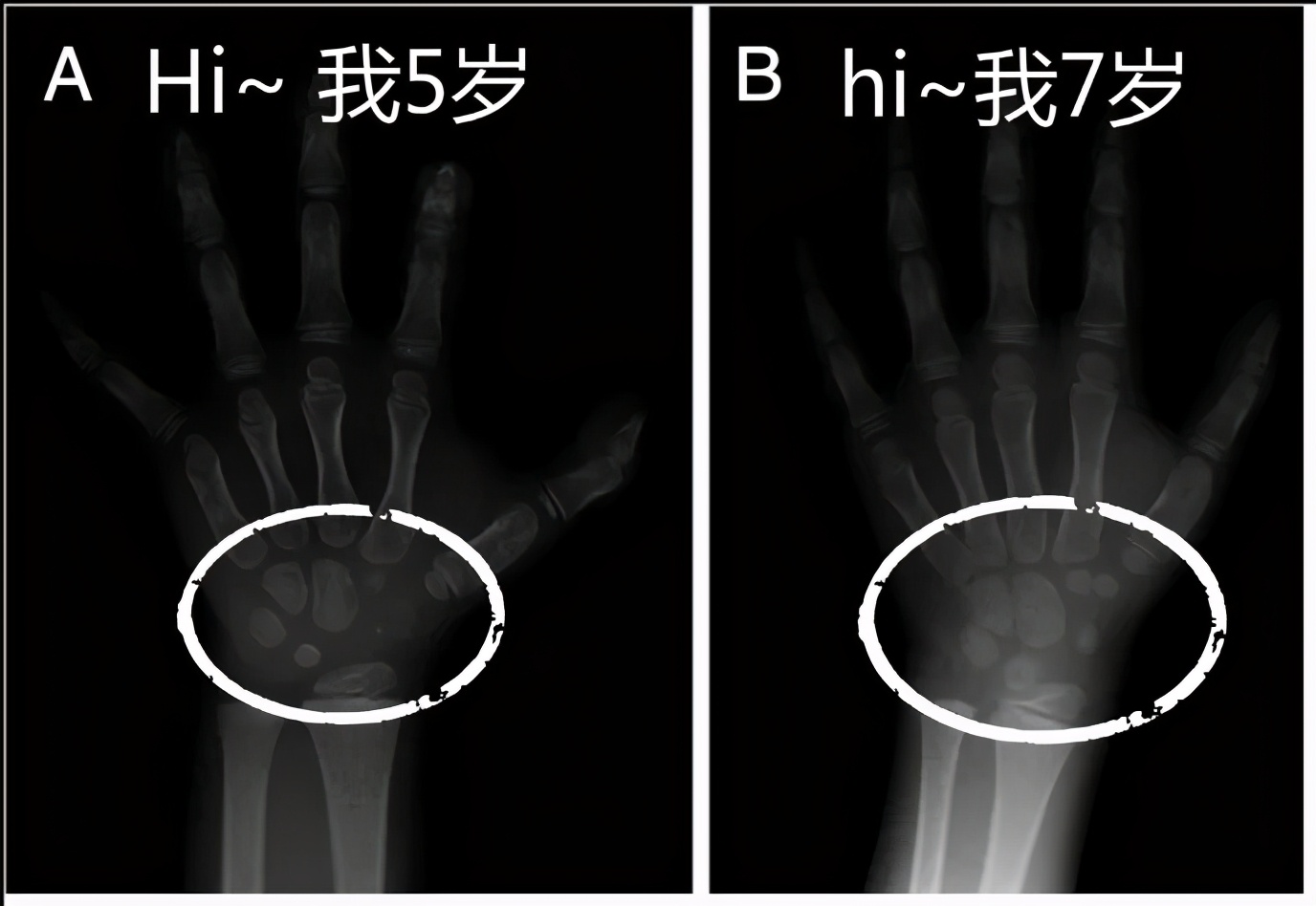 宝宝测骨龄成「新流行」？要不要测，看完这篇，心里有数