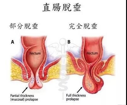 肛门皮赘症状图片(医生) - 赤虎壹号