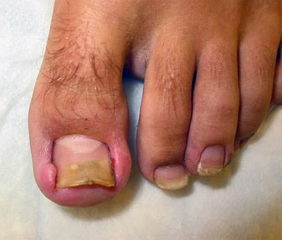 手指甲盖和肉分离图片(脚趾甲老往肉里长) - 赤虎壹号