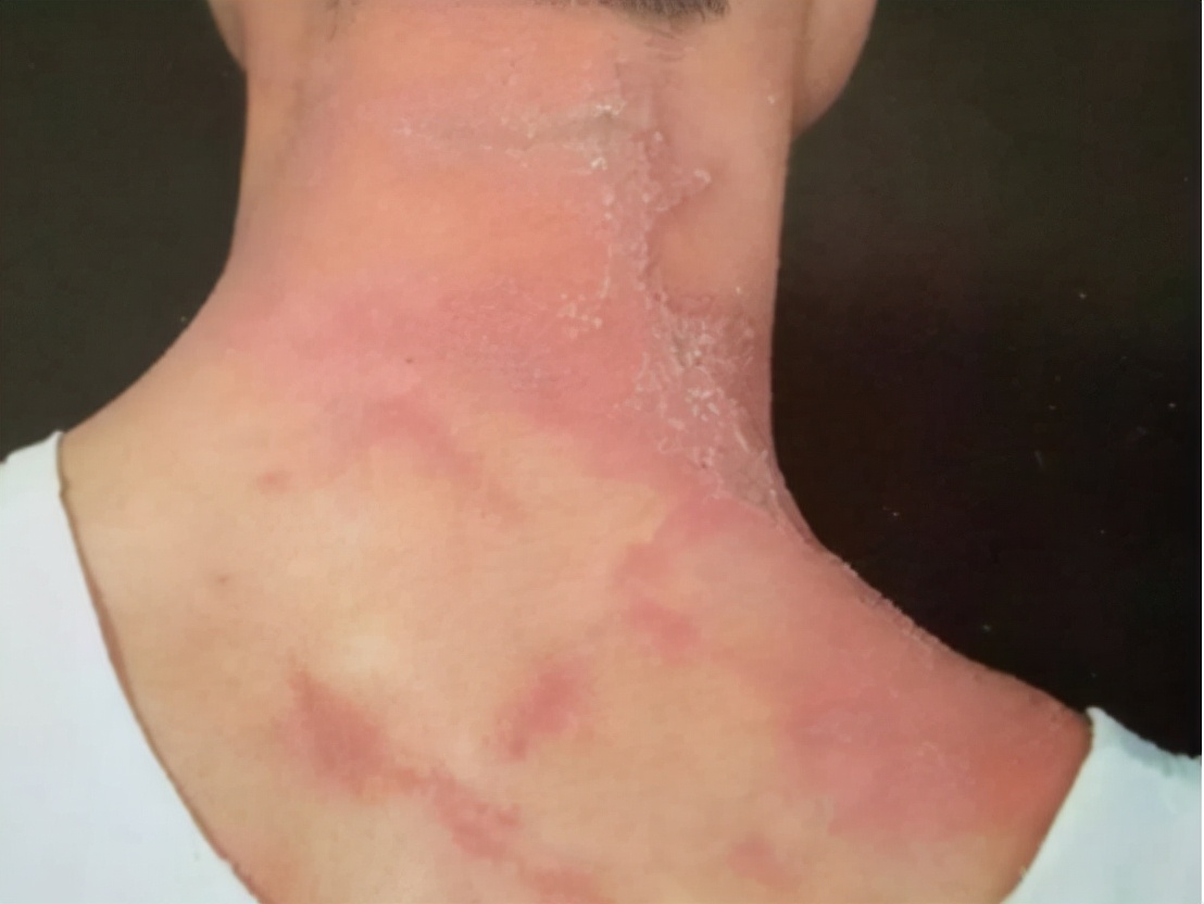 被隐翅虫咬伤急救指南,毒液酸性或可堪比硫酸?