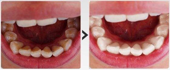 你知道“小巨蛋”吗？10s抗糖美白牙齿，效果比洗牙好太多了