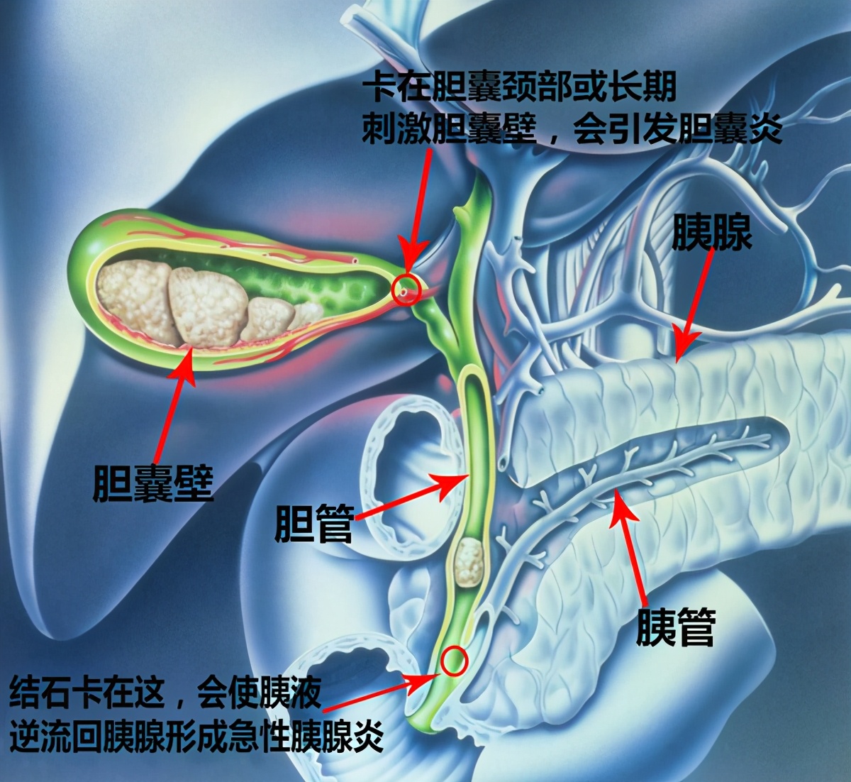 膽囊裡為什麼會長結石?哪些人群更容易被它盯上!一文給你講清楚